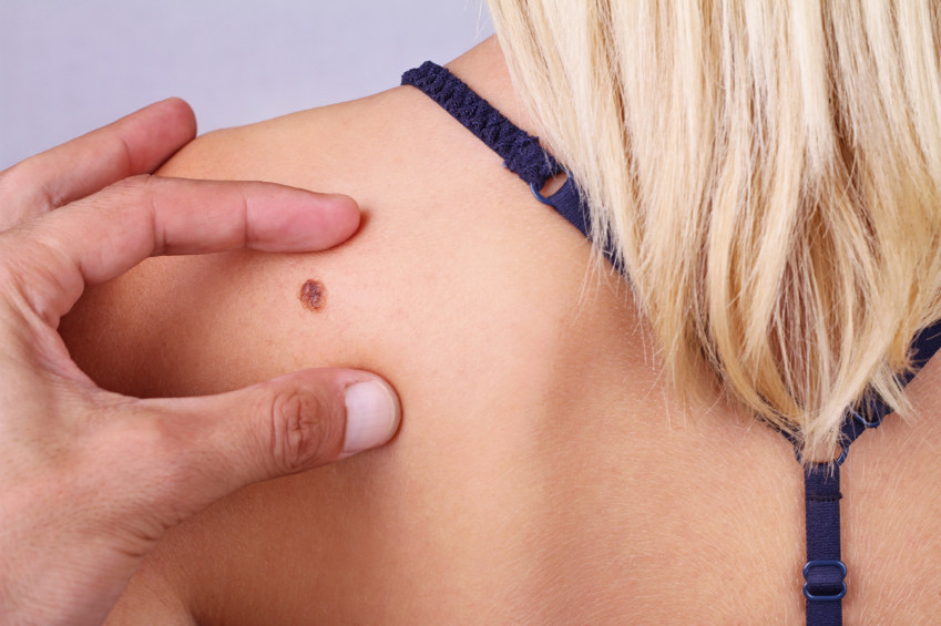 Doctor, dermatologist, hands examines a birthmark of patient. Checking benign moles
